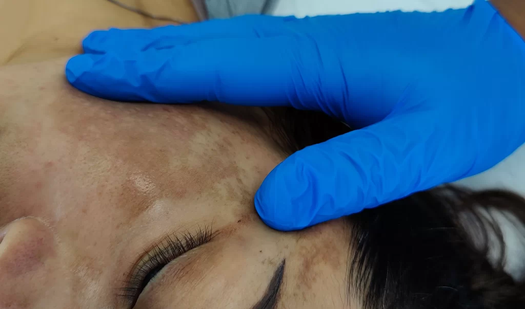 Manchas solares ¿Cómo revertir el daño acumulado en tu piel? - Sunspots: How to Reverse Accumulated Skin Damage?