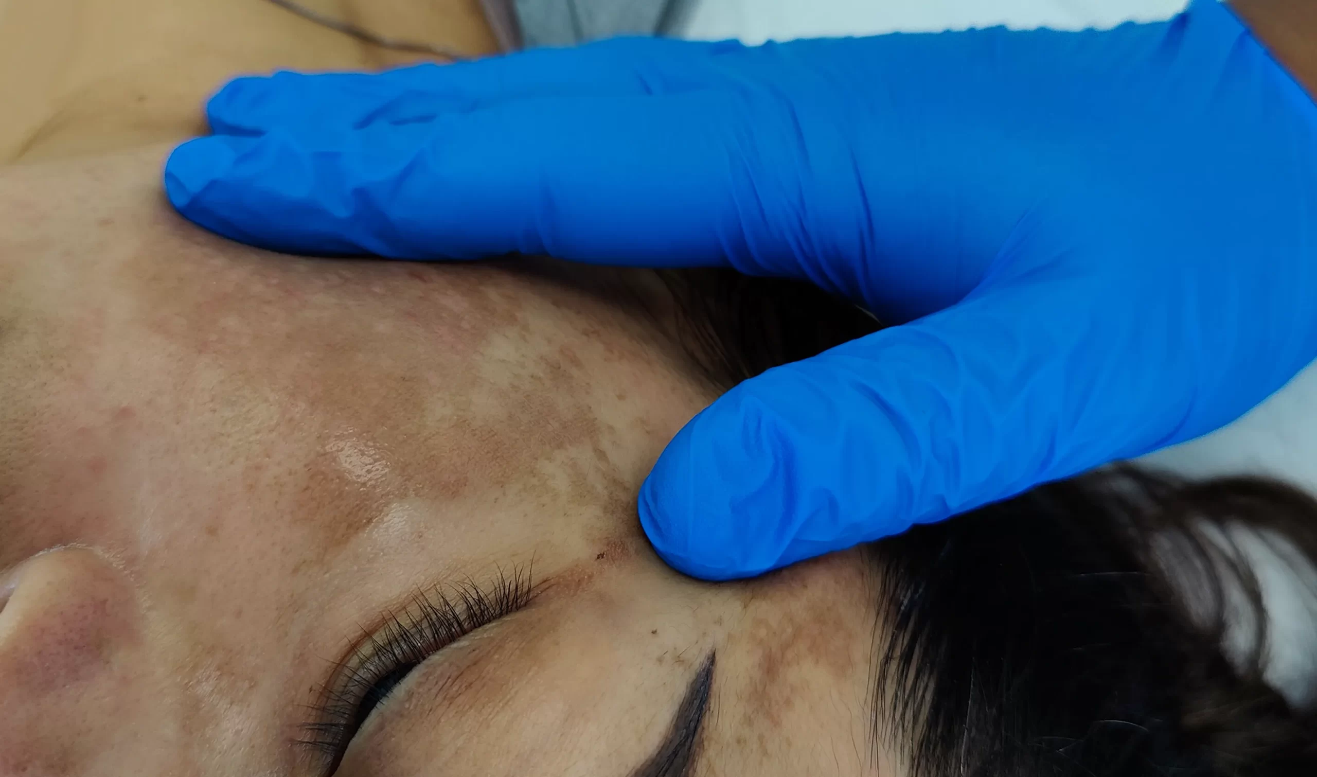 Manchas solares ¿Cómo revertir el daño acumulado en tu piel? - Sunspots: How to Reverse Accumulated Skin Damage?