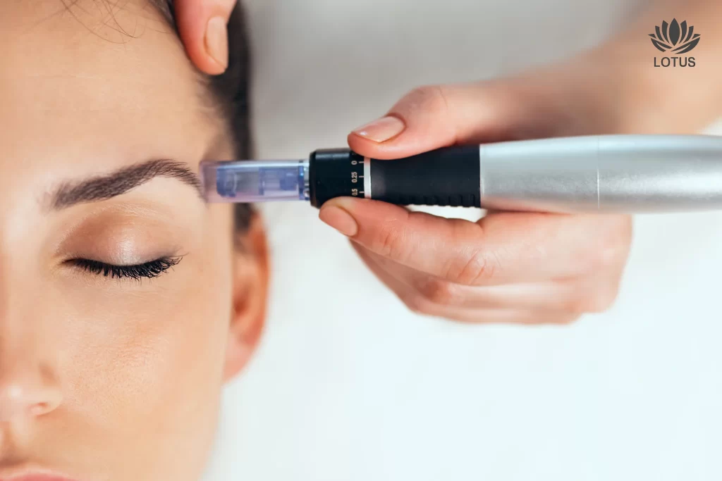 Microneedling en San Leandro El Secreto del Colágeno / Microneedling in San Leandro: The Secret to Collagen for Your Skin