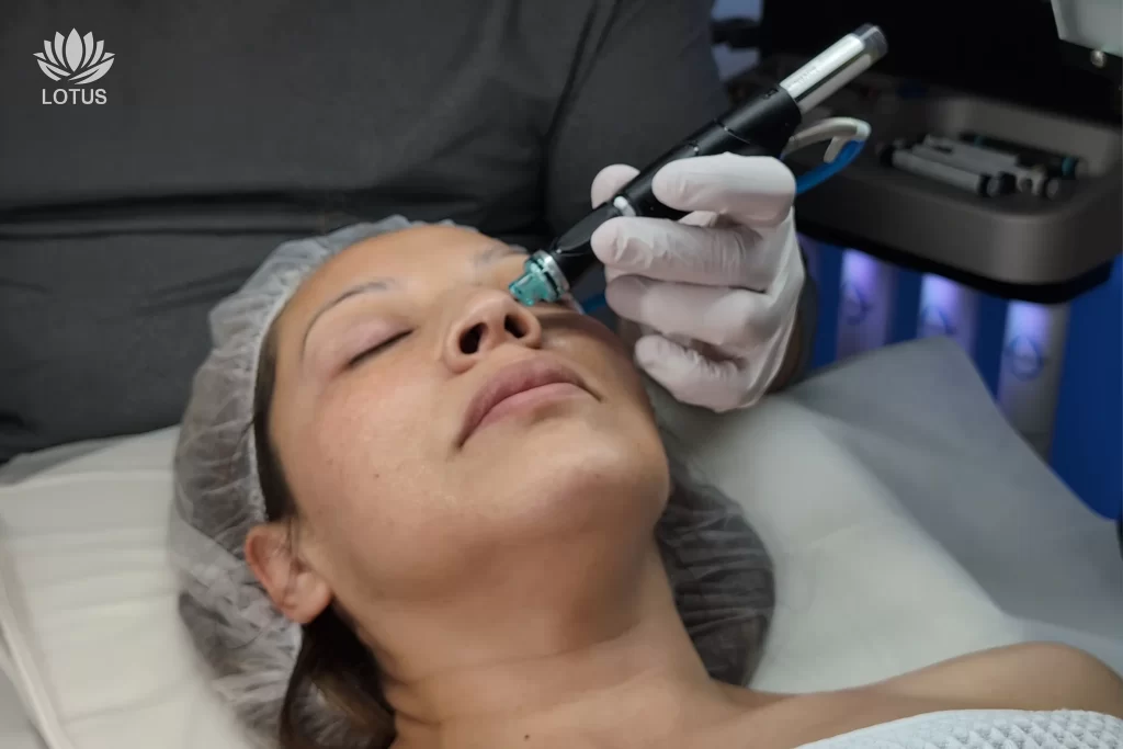 Hydrafacial como tratamiento de Prevención del Cáncer de Piel en San Leandro / Hydrafacial as a Skin Cancer Prevention Treatment in San Leandro
