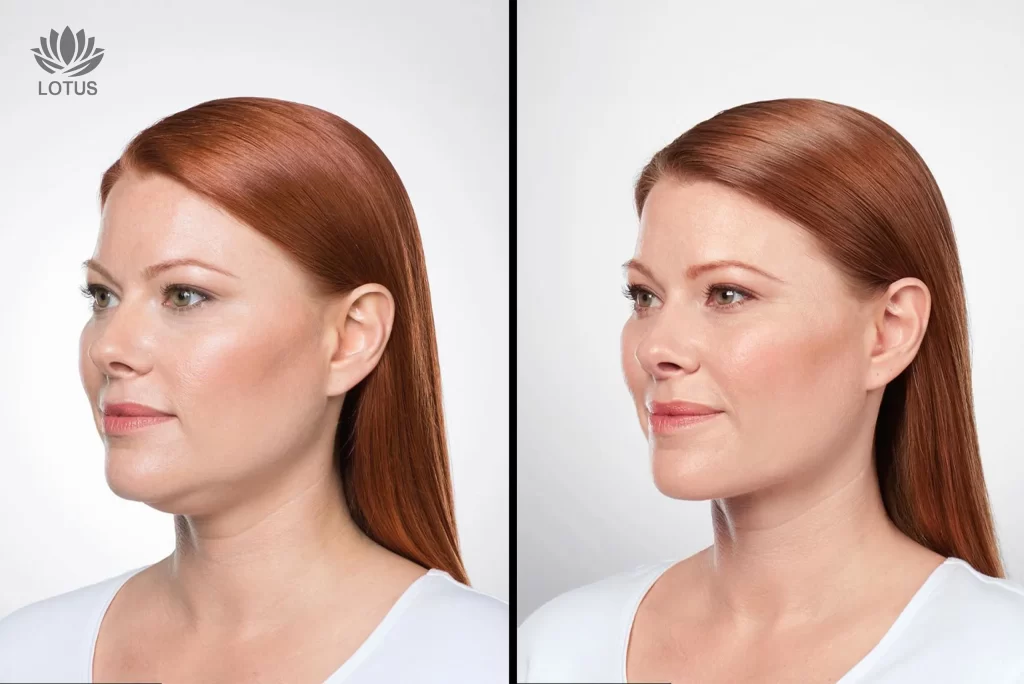 Kybella para eliminar la papada sin cirugía en San Leandro