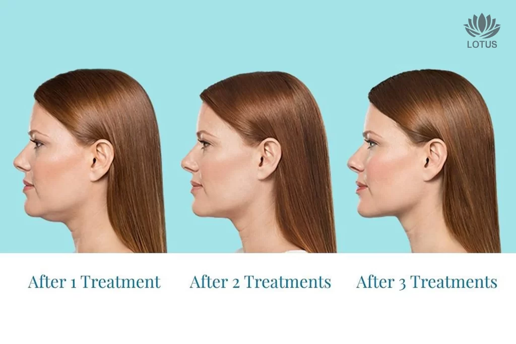 Kybella para eliminar la papada sin cirugía en San Leandro // Kybella to Eliminate Double Chin Without Surgery in San Leandro