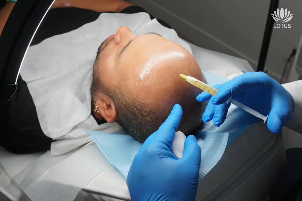 PRP capilar como solución a la caída del cabello / Hair PRP as a Solution for Hair Loss