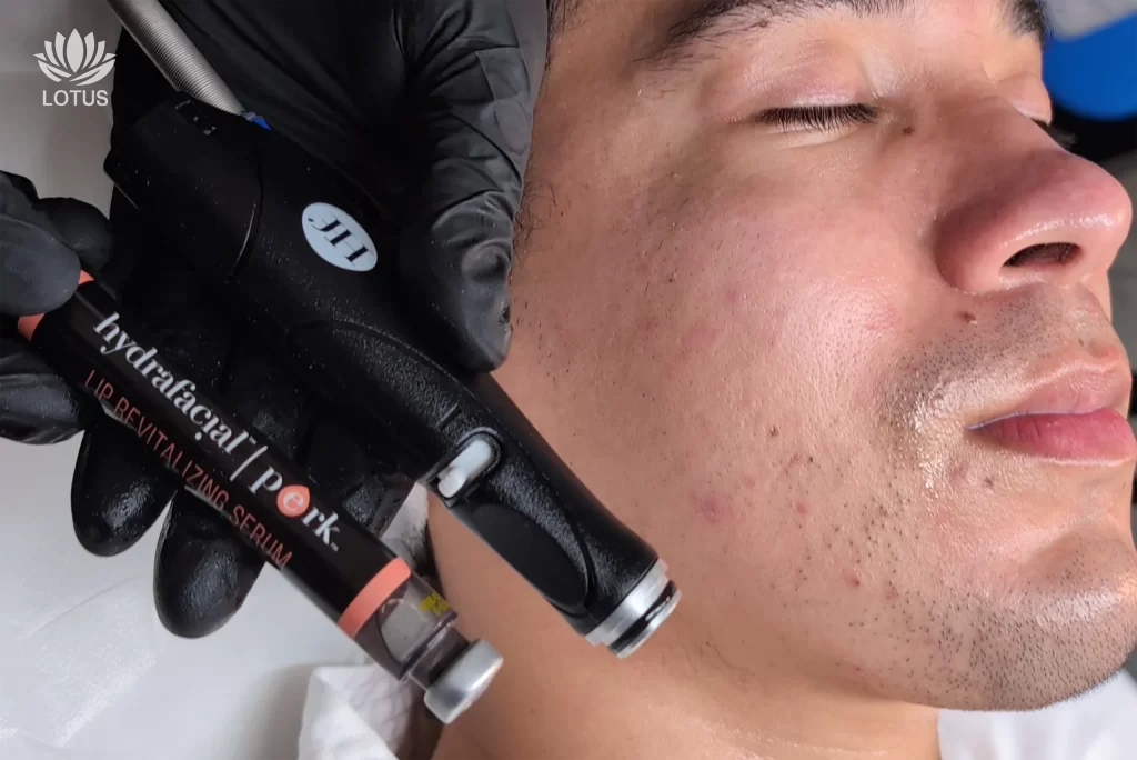 Rejuvenecimiento de Labios y Ojeras en San Leandro | Lotus Esthetic / Lip and Under-Eye Rejuvenation in San Leandro