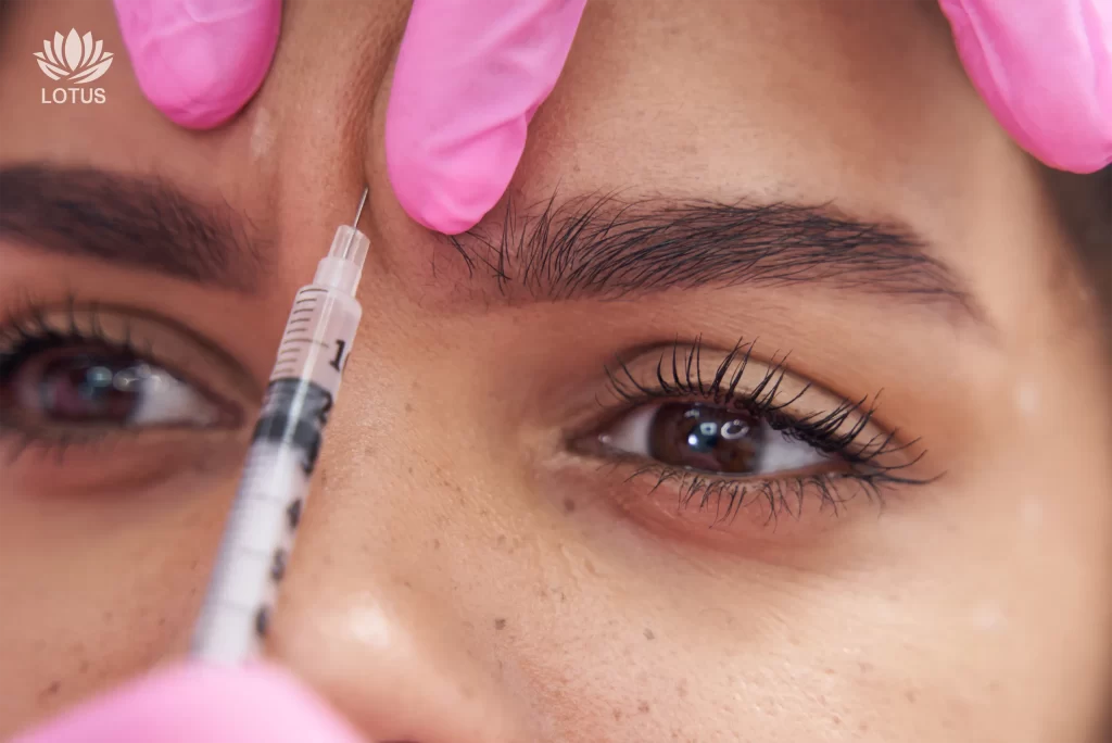 Baby Botox en San Leandro | Toxina Botulínica Preventiva en Lotus