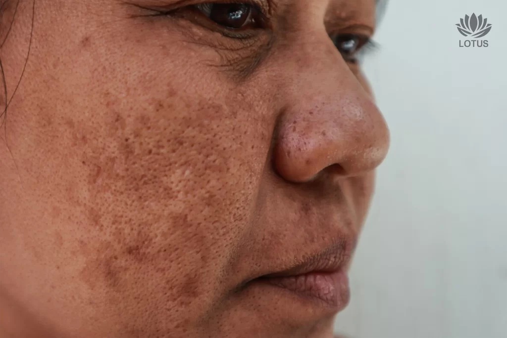 Tratamiento para Manchas en San Leandro | Hiperpigmentación // Dark Spot & Treat Skin Hyperpigmentation in San Leandro