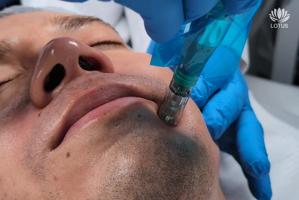 Microneedling con PDRN en San Leandro | Regeneración Facial // Microneedling with PDRN in San Leandro | Skin Regeneration