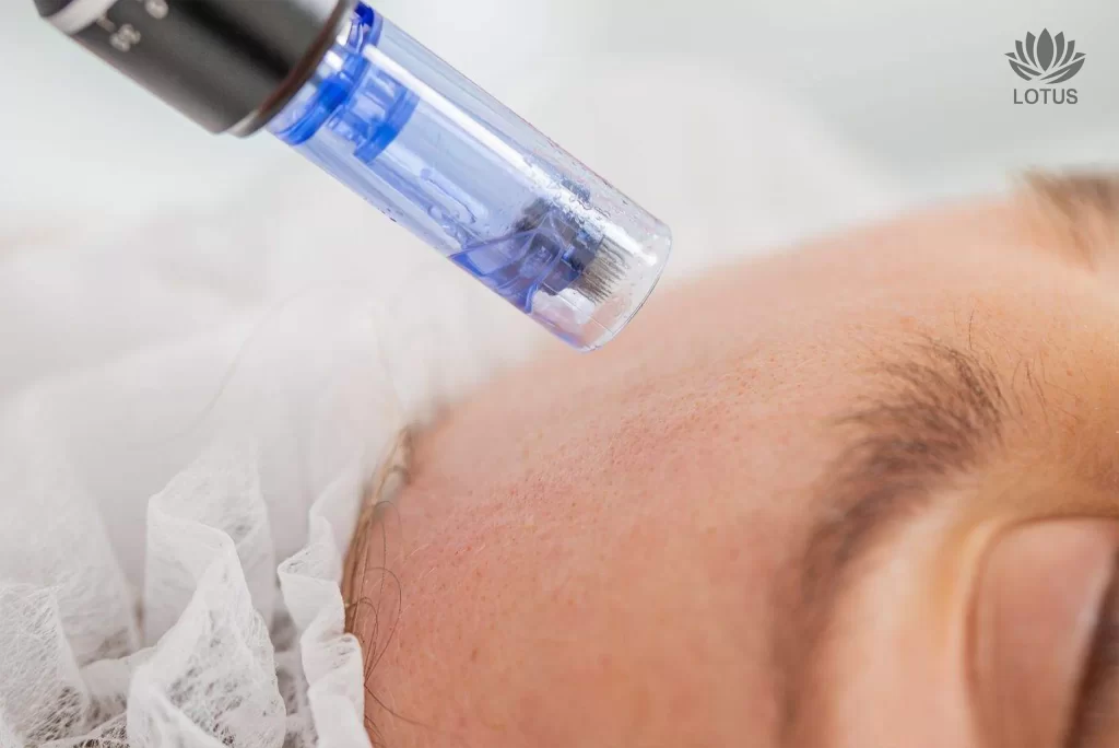 Microneedling con PDRN en San Leandro | Regeneración Facial // Microneedling with PDRN in San Leandro | Skin Regeneration