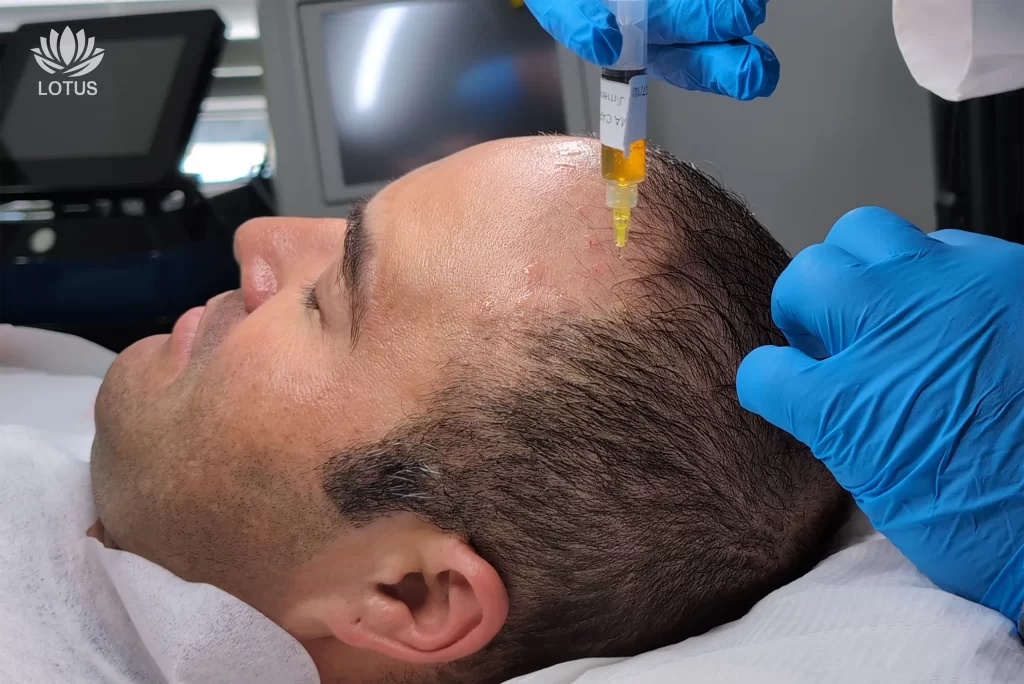 Caída del Cabello en San Leandro | Tratamiento de PRP // Hair Loss in San Leandro | PRP Hair Treatment at Lotus