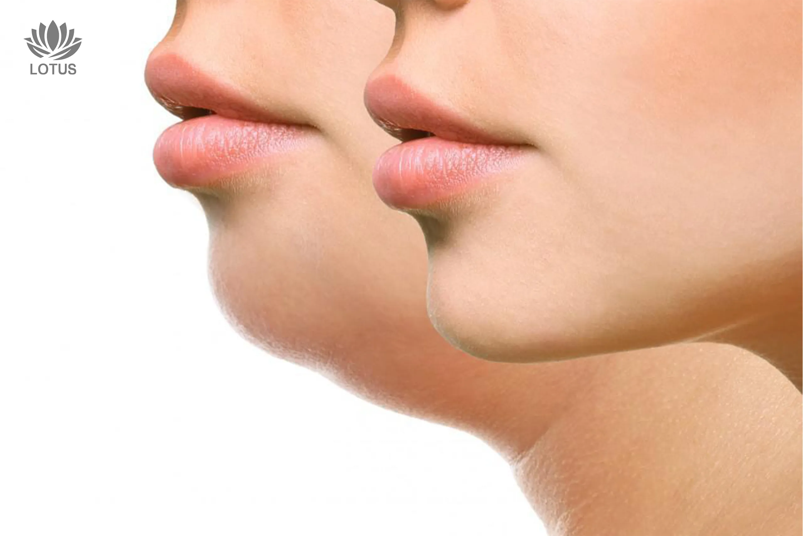 Tratamiento para el Cuello de Pavo en San Leandro // Non-Surgical Turkey Neck Treatment | Double Chin Removal